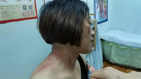 揪痧风潮席卷现代健康潮流，最新揪痧成为健康新选择