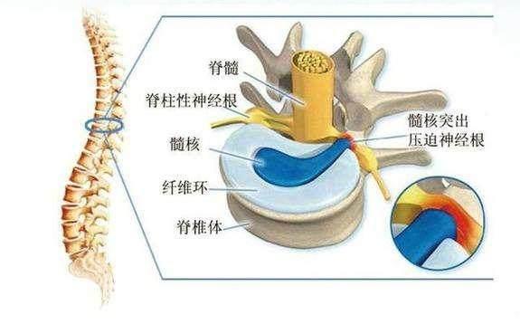 腰椎间盘突出最新治疗方法，科技重塑健康，助力轻松康复