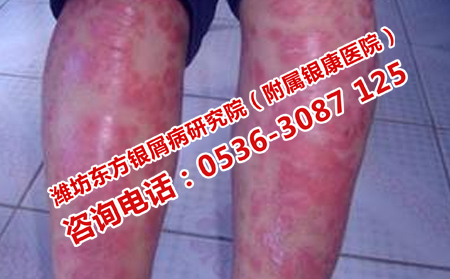 银屑病最新治疗方法及其论述探讨
